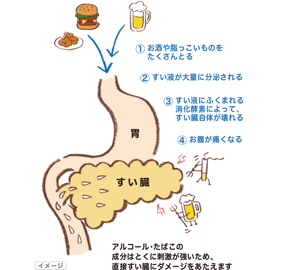 イラスト：慢性すい炎の痛みの原因イメージ